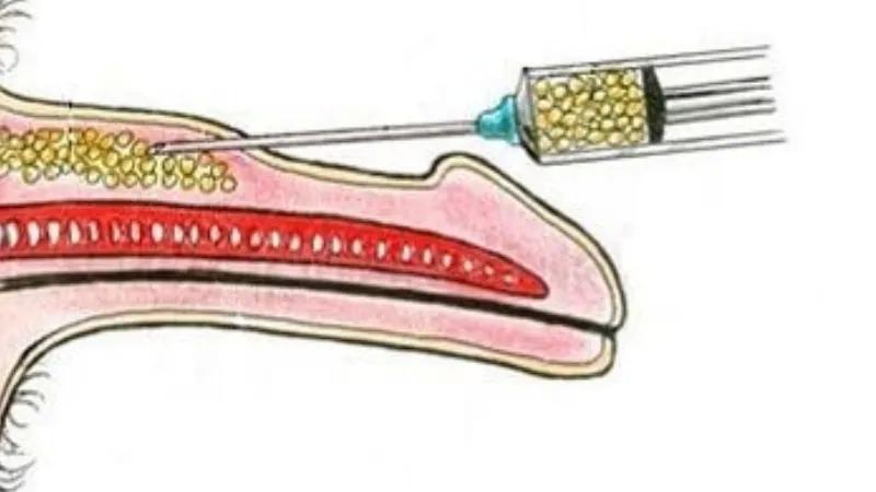 Non-Surgical Penis Enlargement Methods