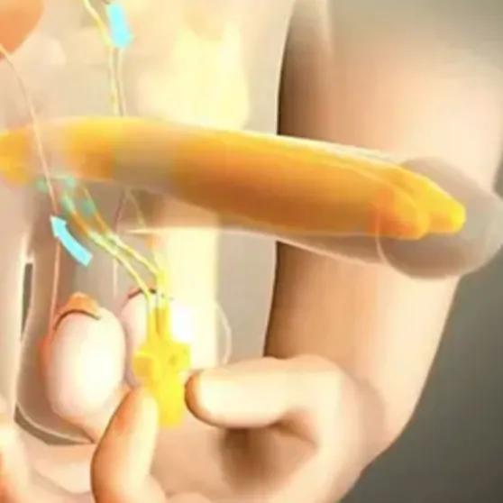 Penile Prosthesis (Happiness Rod) Surgery