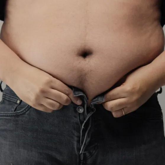 Pubectomy and Pubic Liposuction