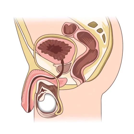 Scrotal Web Excision